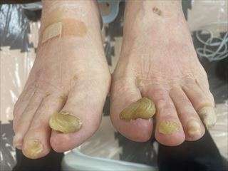 年配の方の足の爪