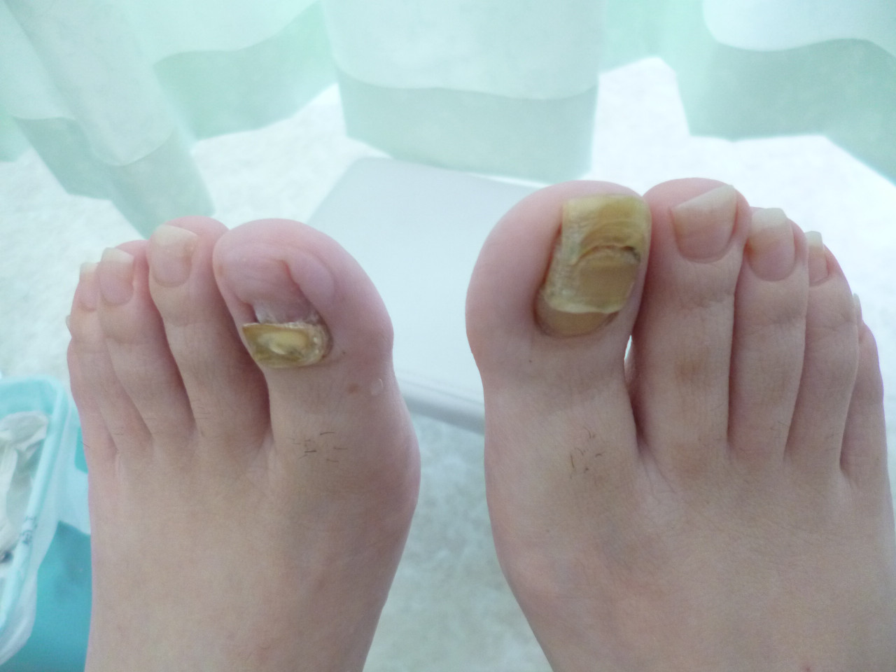 私の足の爪 分厚くなってる 奈良で爪 フットケアを行うアルシアが耳寄り情報を発信するブログ